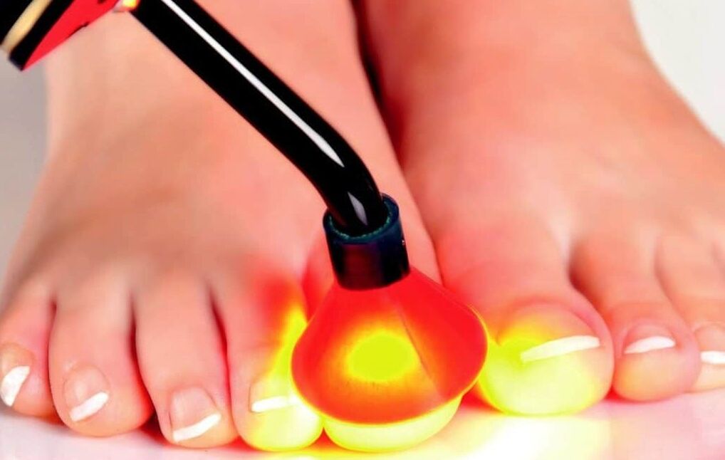 Laserové ošetrenie nechtovej dosky